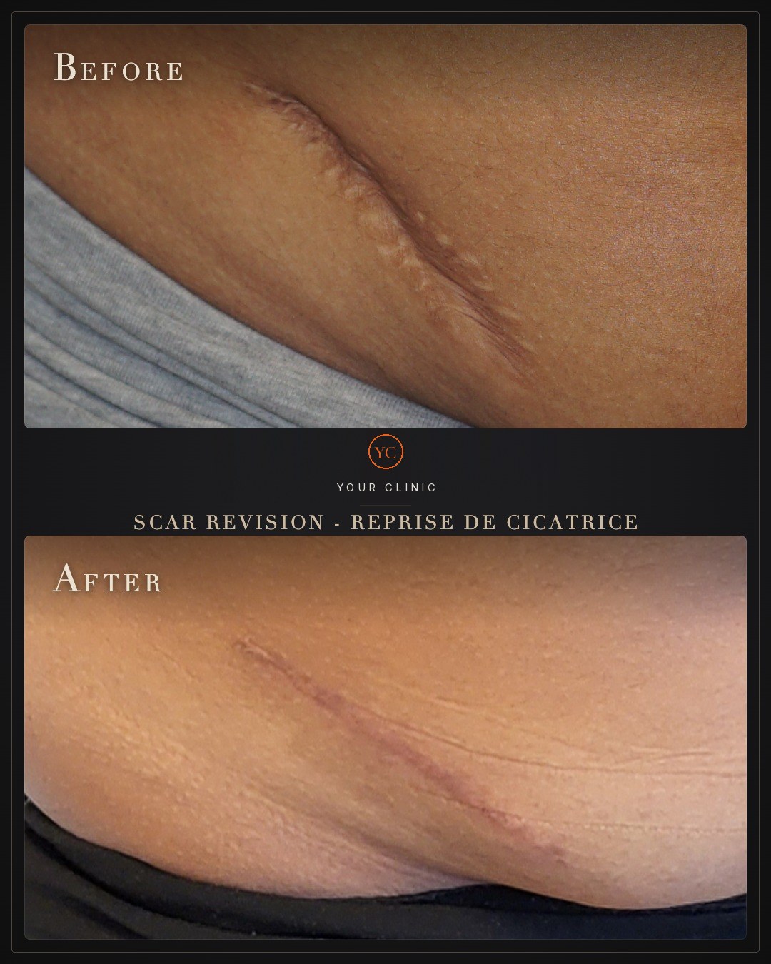 Before/after collage made with Lumipair, Noir template: scar revision